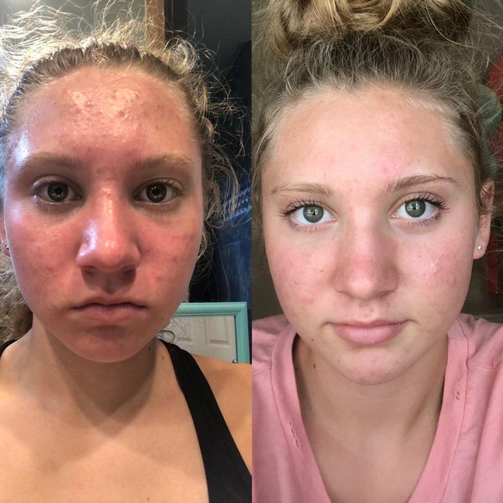 acnetame before and after